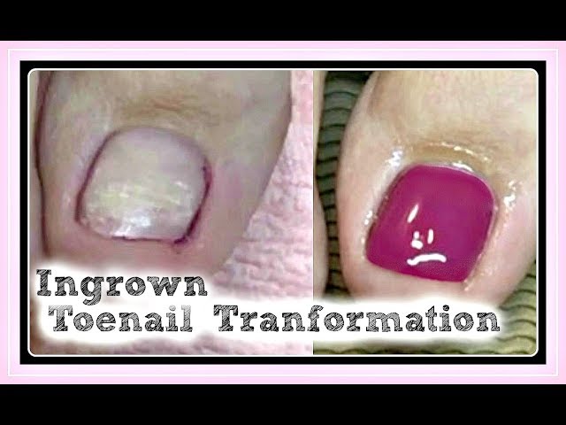  Pedicure Tutorial and Ingrown Toenail Treatment Transformation Using Hard Gel ✔