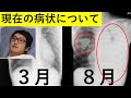 今の病気の現状と、この先どう考えているか赤裸々に話します