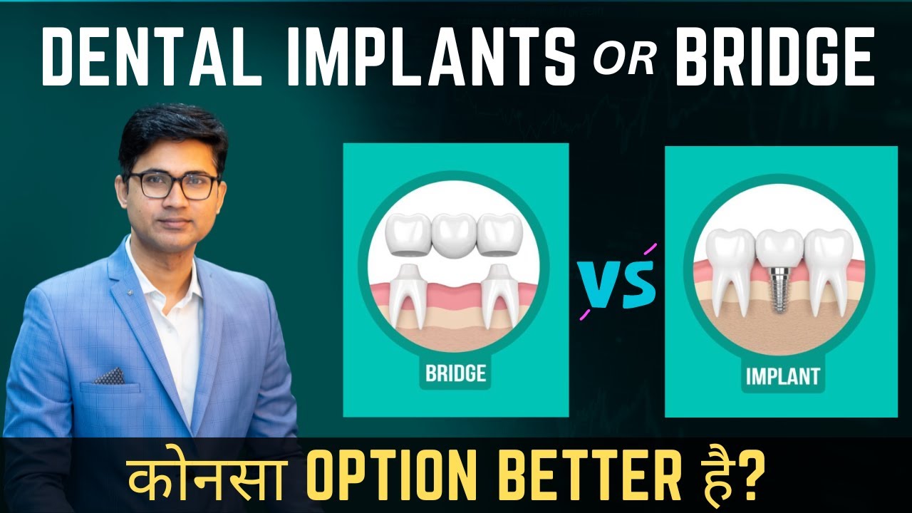 Dental Implant vs Bridge | In Hindi | Missing Teeth के लिए क्या बेहतर है?