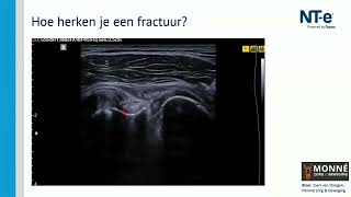 Casus echografie 'displaced greater tuberosity fracture'
