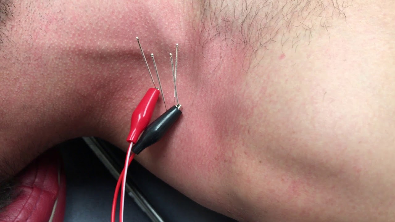 Electrical Dry Needling for Auricular Vagus Nerve Stimulation