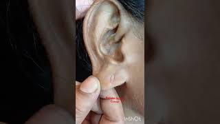 Ear lobe Repair Treatment 🙏 #reels  #piercing #lshorts #thenitumakeover #earlobetreatment