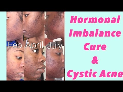 What happened to my face?? PCOS Hormonal Imbalance Cure | Cystic Acne Cure