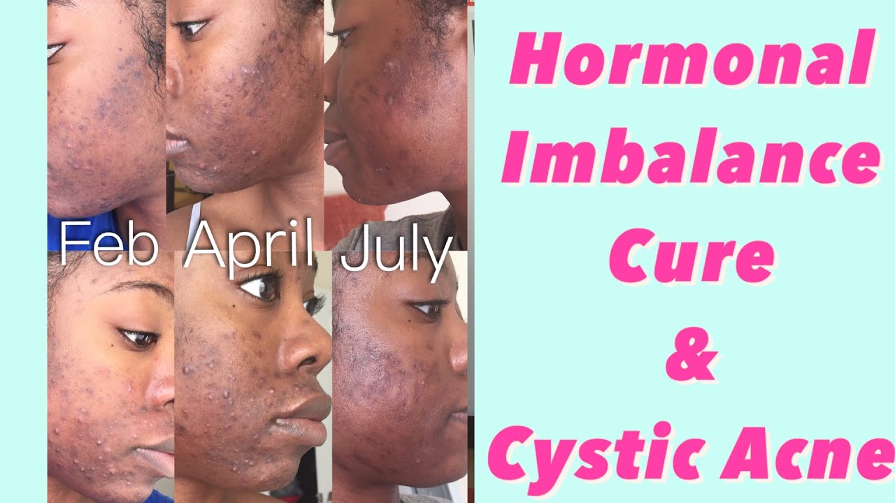 What happened to my face?? PCOS Hormonal Imbalance Cure 