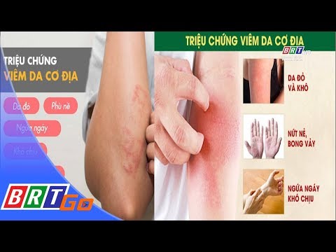 Viêm da cơ địa | BRTgo