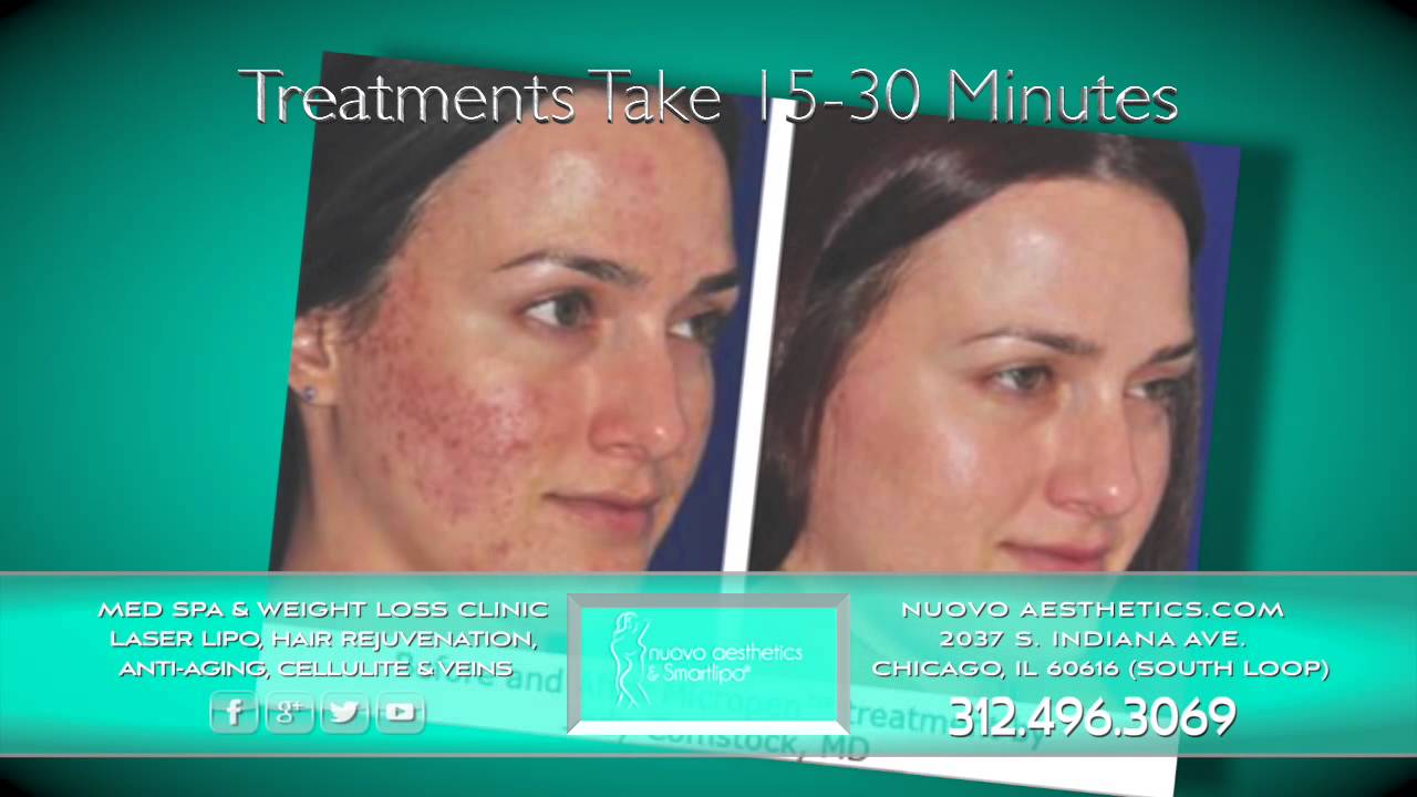 Stretch Marks & Acne Scar Removal Treatment Chicago IL YouTube