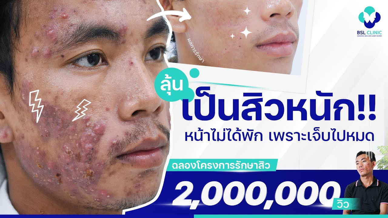 พร เกษม เดอะมอลล์ บางกะปิ 2022 Update การรักษาสิว 179 วัน l EP 1 จุดเริ่มต้น