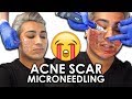 FIXING MY ACNE SCARS (TEXTURED SKIN) | $400 Vampire Facial Treatment