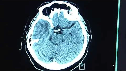 Wie lange lebt man mit gutartigen Hirntumor?