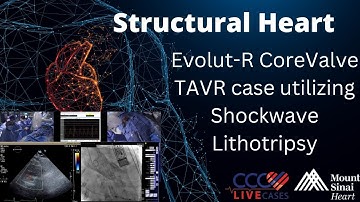 Evolut-R CoreValve TAVR case utilizing Shockwave Lithotripsy – September 2019