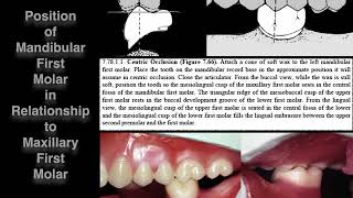 Complete Dentures 1 - 9) Posterior Setup