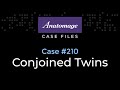 Pathology in 3D: Conjoined Twins