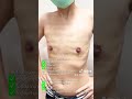 3 อาทิตย์หน้าอกแบนจริง ไม่มีถุงเดรน!” หน้าอกเรียบ พร้อมปั้นกล้าม เป๊ะทุกองศา!หมอตู่-จักรรินทร์