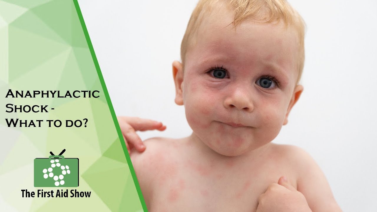 Anaphylactic Shock What to do? YouTube