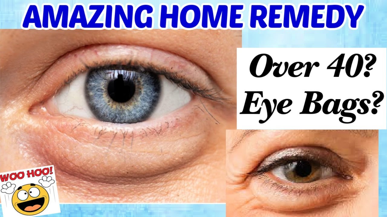 Home Remedies To Get Rid Of Eye Bags  Home Pictures  Easy Tips