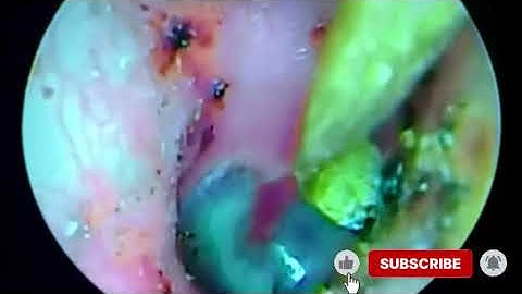“Years of Ear Wax Removed  | Realistic Deep ASMR Cleaning”
