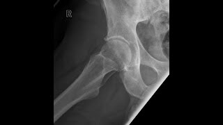 Radiographic Positioning/Procedures involving the Pelvis and Hip