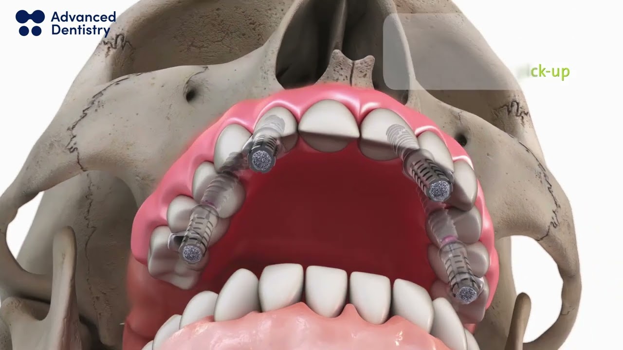 Straumann ProArch BLX