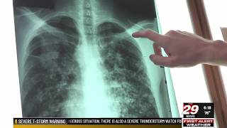 UVA Health joins national sarcoidosis registry to improve treatment and research