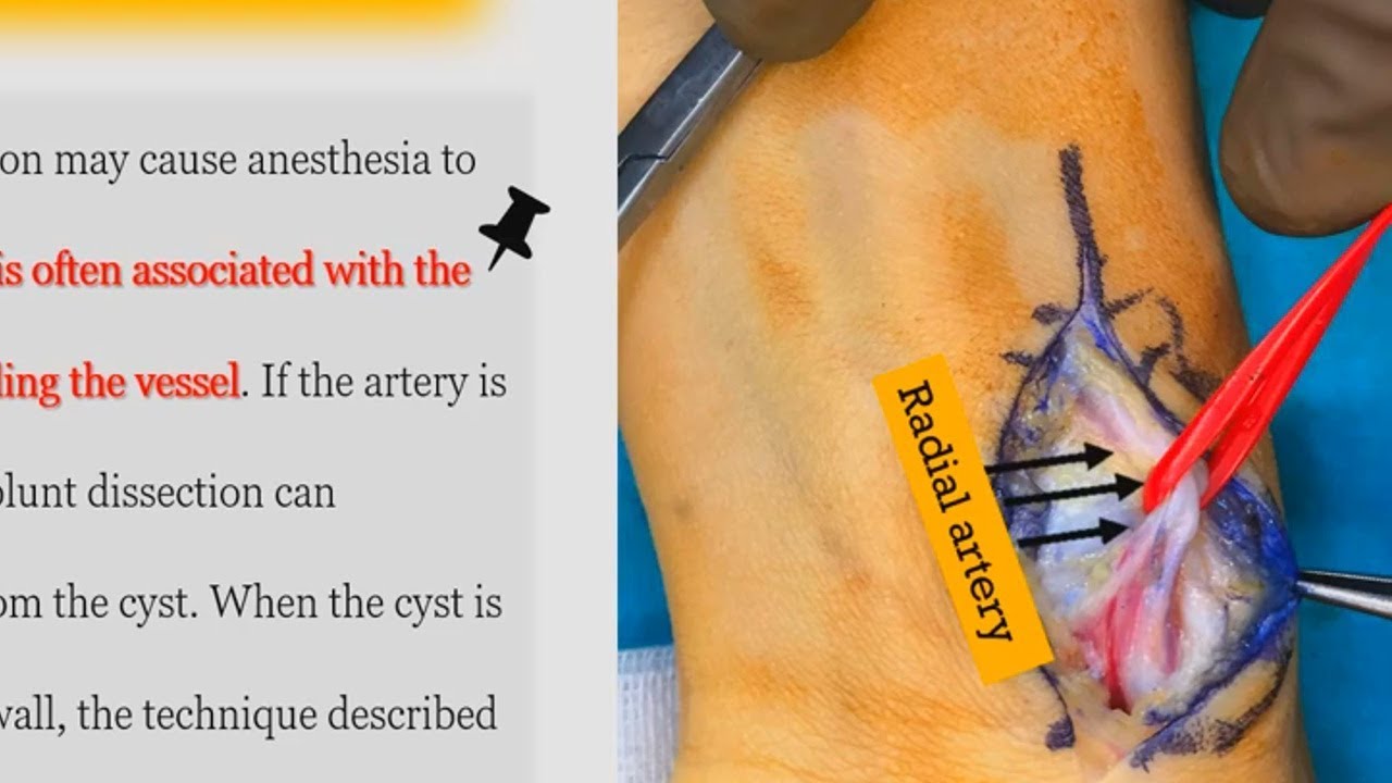 Volar Ganglion Cyst of the Wrist