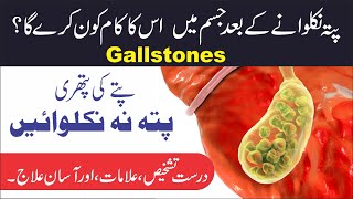 Gallstones ||  پتے کی پتھری  || Ubqari Knowledge