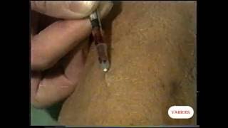 Extracción de varices en las piernas(Todos estos videos se distribuyen, para mayores de edad, con propósitos académicos, especialmente interesante para los estudiantes de medicina., 2014-09-08T09:52:37.000Z)