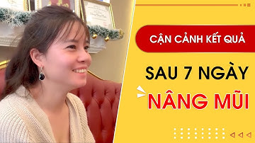Nâng Mũi S Line cao sang chảnh sau 10 ngày | Bác Sỹ Tuấn Dương