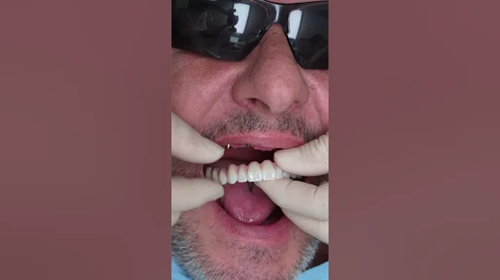 Dental implant’s All on 4 v Praze #shorts #dentist #dental #implant #veneers - DayDayNews