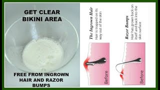 Natural remedy for bikini area ingrown ...