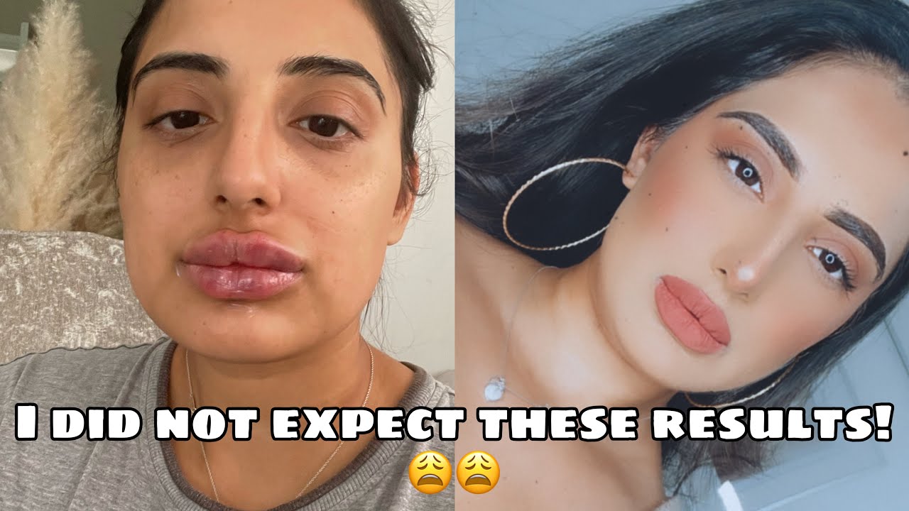 GETTING MY LIPS DONE I DID NOT EXPECT THESE RESULTS | RUSSIAN LIP FILLERS | AMAN BRAR | TAUR BEAUTY