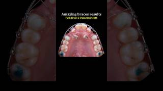 Amazing braces process: Pull out x2 canine teeth to correct position #braces #dentist #orthodontics