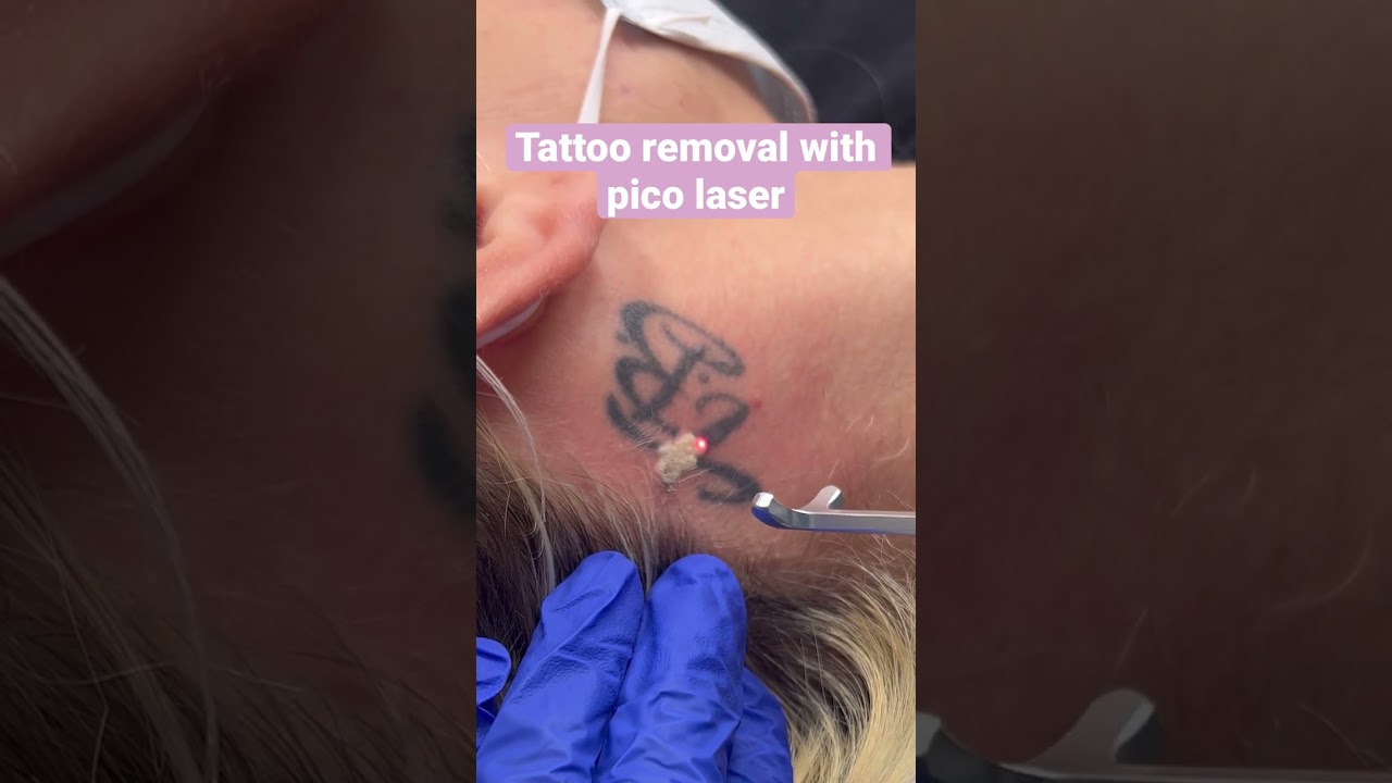 Tattoo Removal with Pico Laser | Dr. Swati Kannan 
