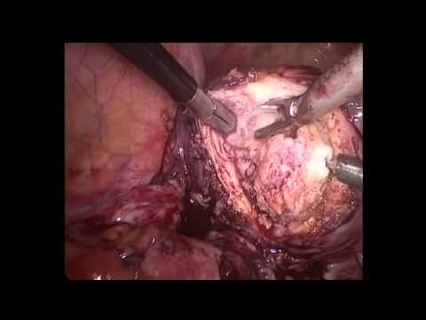 Resection of rectovaginal endometriosis done by Dr Nikita Trehan at Sunrise Hospital, New Delhi 1