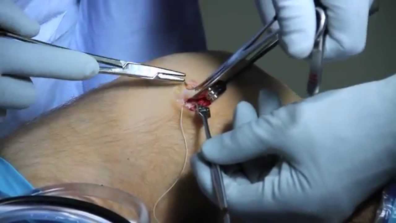Dislocating Knee Cap Surgery - MPFL Reconstruction - YouTube