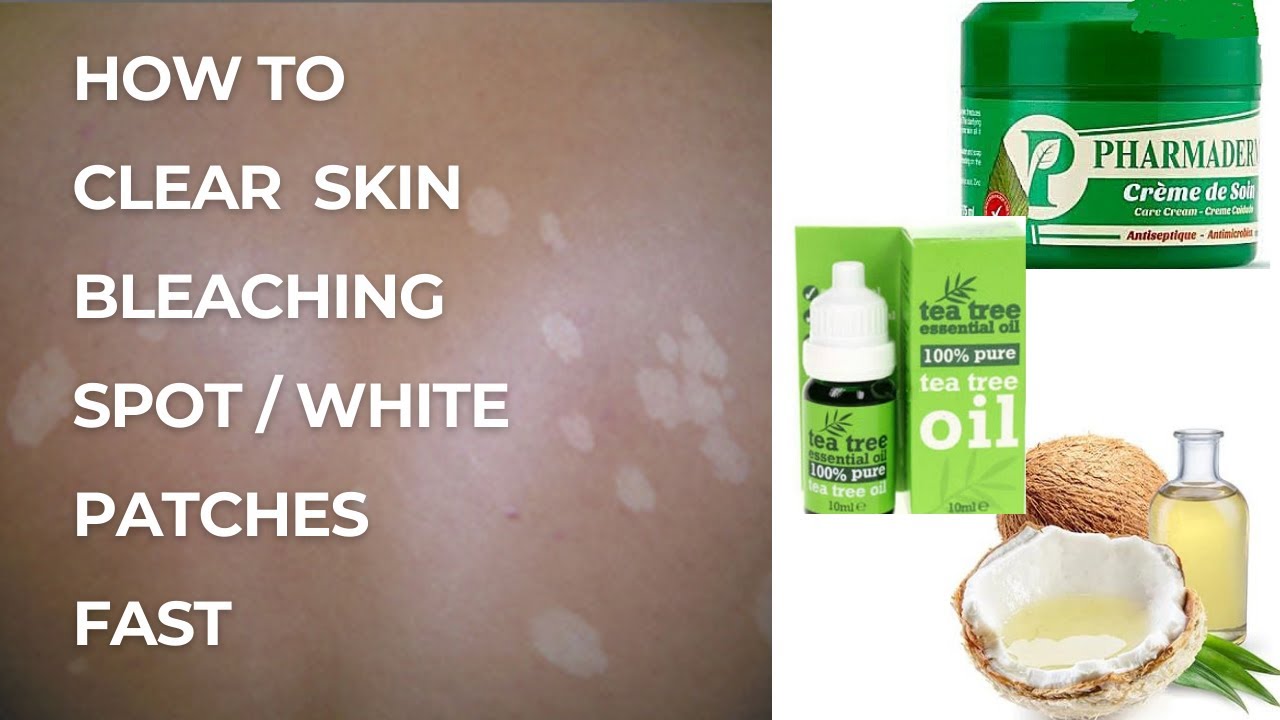 How to clear white patches / Bleaching Spot /Cream reactions / white