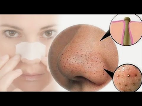 Video: Kako izbijeliti kožu: 10 koraka (sa slikama)