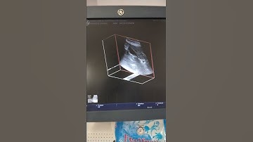 Gallbladder scaning. 3D  ultrasound