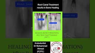 ROOT CANAL TREATMENT (RCT) Forms bone destroyed by infection,Large Bone Lesion heal after Root Canal
