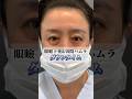 眼瞼下垂&切開ハムラで若返り👀#眼瞼下垂 #切開ハムラ #ダウンタイム