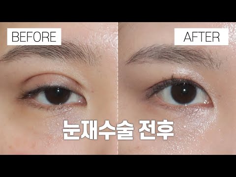 눈 성형 전후 I 눈재수술 I 강남서연