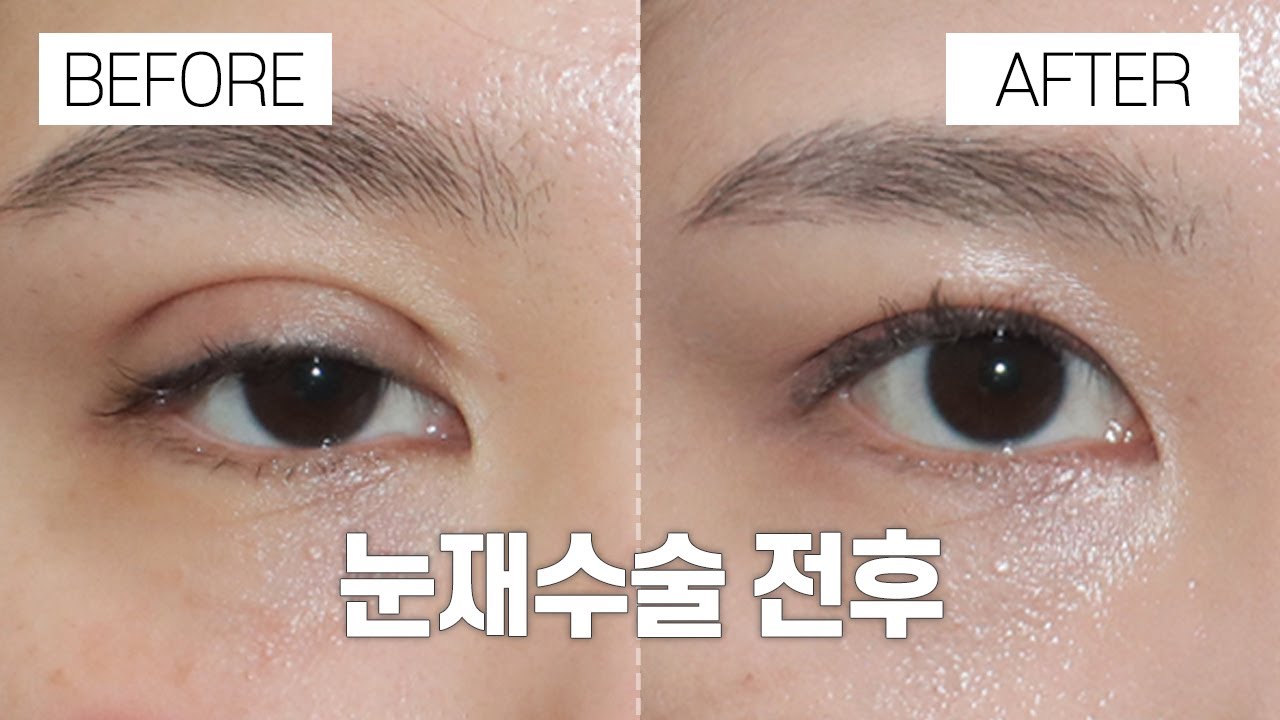 [강남서연성형외과] Phẫu thuật mắt trước và sau I Phẫu thuật mắt lại I Gangnam Seoyeon