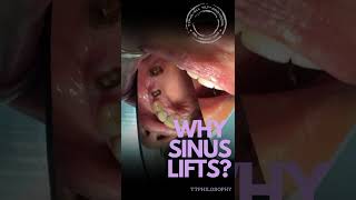 SINUS LIFTS?? AVOID WHEN AVOIDABLE. TTPHIL: ALL TILT PROTOCOL #implant #thedentalspecialists