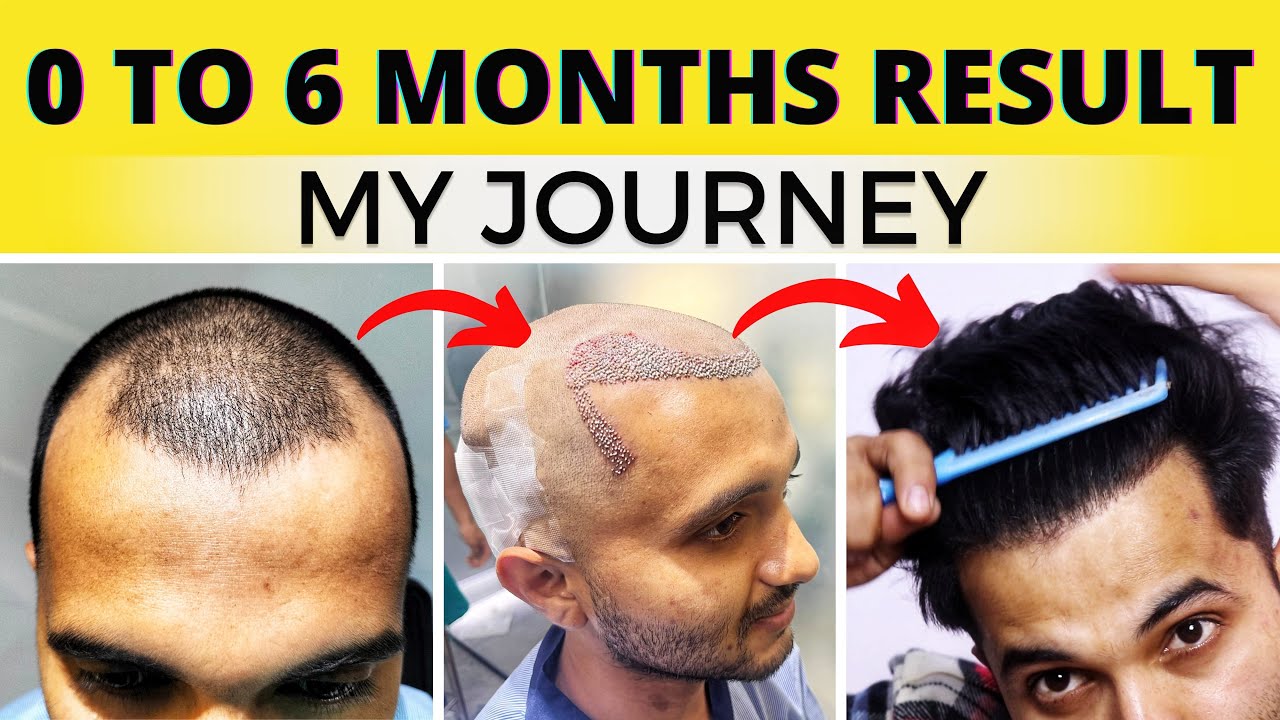 My Full Hair Transplant Journey From Day 1 To 6 Months || Best Hair Transplant Result In India 2022