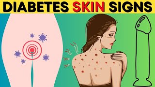 Top 12 Diabetes Skin Signs, Symptoms & Treatment [Type 2 & 1 Diabetes] screenshot 1