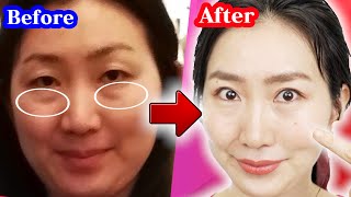 The True Cause to Worsen your Under Eye Bags and How I Finally Removed Mine Suffered since 2019