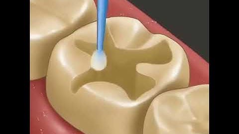 Light cure composite filling