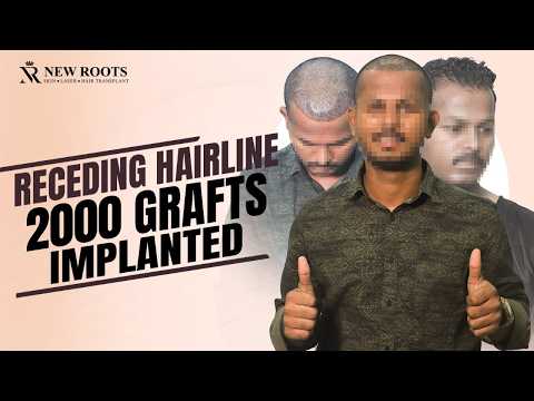 Hairline Back Soon 🔥 | Receding Hairline Hair Transplant in Mumbai | New Roots