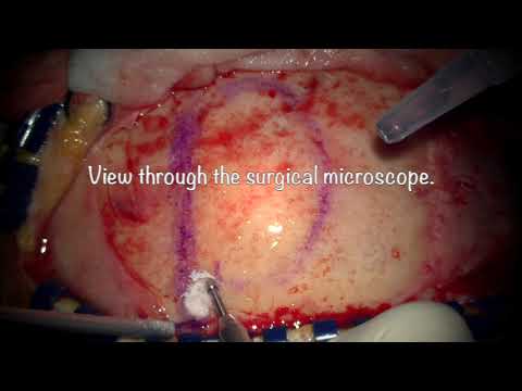 Video: Meningioma Otak: Rawatan, Pembedahan, Prognosis, Sebab