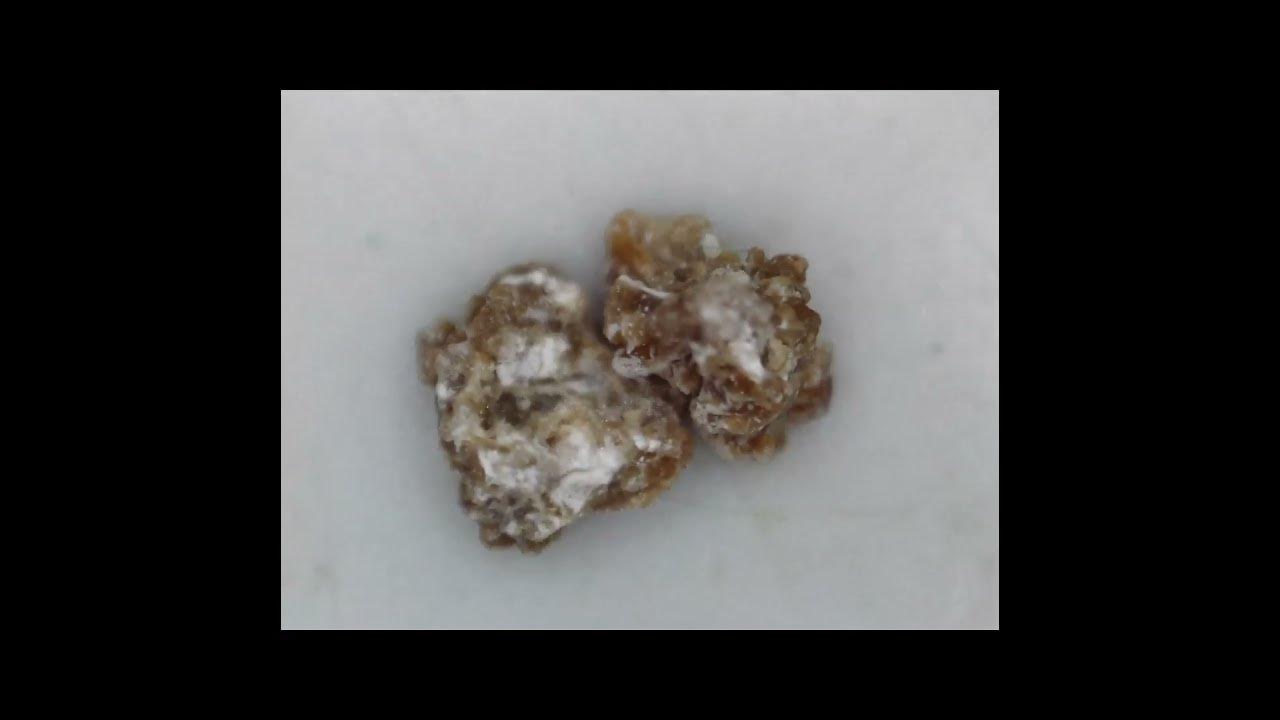 what does a kidney stone look like science weird boredom microscope