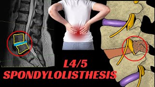L4/5 spondylolisthesis: Everything you need to know